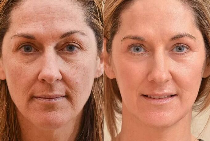 Face rejuvenation before and after