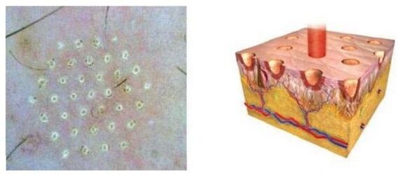 The fractional laser affects the skin point