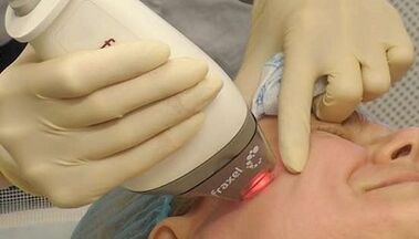 How does fractional skin rejuvenation work