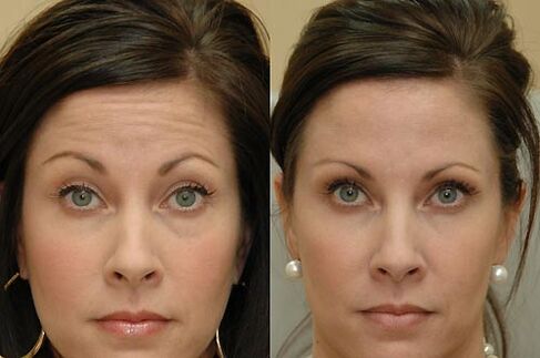 Botulinum toxin injections can be used on any area of ​​the face