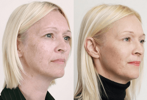 Medium fruit acid peel