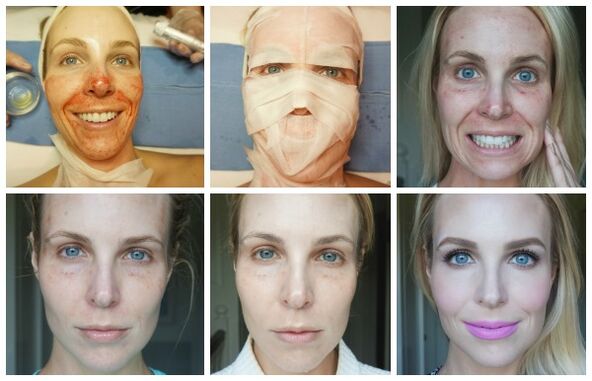 Facial skin healing stages after successful plasma facelift