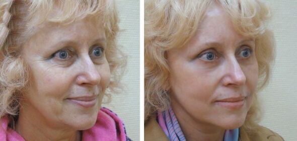 Woman before and after plasma facial skin rejuvenation